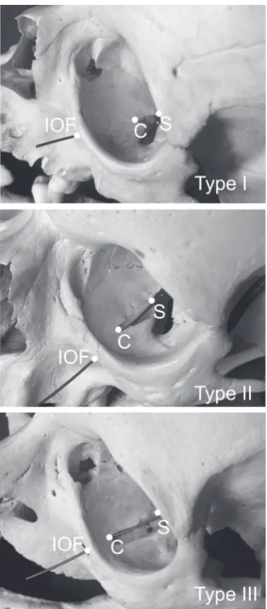Figure 3. The frequency of the infraorbital canal/groove complex types; R — right: L— left.
