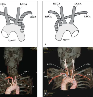 Figure 5. A drawing (A) and a multislice computed tomographic image (B) of type IV with the right subclavian artery (RSCA) arising as an arteria lusoria in patients with a left-sided (A) and a right--sided arch of the aorta (B); LSCA — left subclavian artery; LCCA and RCCA — left and right common carotid arteries.