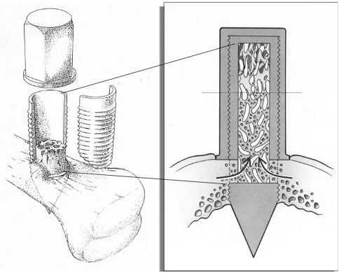 Figure 1A schematic drawing of the Bone Conduction Chamber (BCC). Frozen bone allografts are placed for 6 weeks in the chambers,which are implanted in the proximal tibia of rats