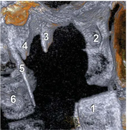 Figure 5. Bilateral scalariform styloid process, consisting of twopieces joined by a pseudoartrosis (arrows); A