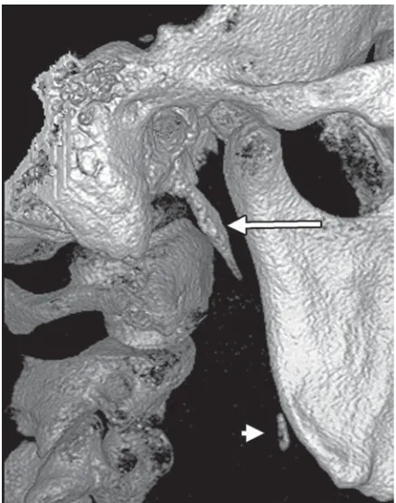 Figure 9. Outer view of the right styloid process (3DVR, boneview mode). The stylohyal (arrow) and a small ossification point(arrowhead) of the ceratohyal are indicated.
