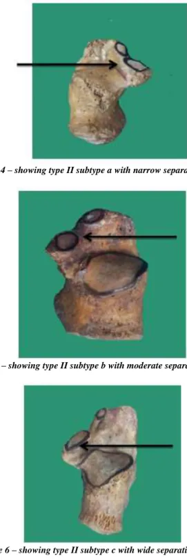 Figure 4 – showing type II subtype a with narrow separation <2mm 