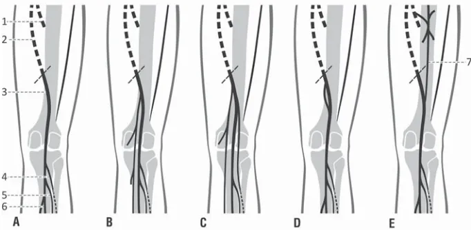 Figure 1. Patterns of deep venous system distribution within popliteal fossa and variations in the formation of popliteal vein; popliteal vein within the popliteal fossa; three tributaries; A