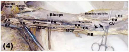 Figure 2. Light photograph of a right female upper limb showingthe abnormal high-origin (black arrow) radial artery (RA) crossing(open arrow head) the median nerve (Mn) and brachial arterysuperficially