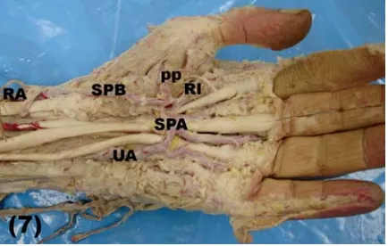 Figure 5. Light photograph of a right upper limb showing branch-es of the radial artery (RA) within the forearm including the radialrecurrent artery (RRA), muscular (open arrow heads) and palmarcarpal branch (arrow); BA — brachial artery; Mn —  mediannerve; U —  ulnar; AP — abductor pollicis longus tendon;EPB — extensor pollicis brevis tendon; PL — extensor pollicislongus; FCR — flexor carpi radialis.