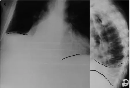 Figure 2: PA and lateral chest radiographs with incomplete field of view due to technical processing damage.