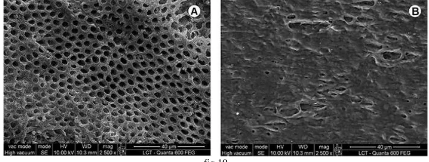 fig 10 Fig 10 A shows dentin free of smear layer with open tubules; B) shows dentin fusion and solidification after  
