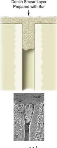 fig 1 Fig 1 shows the different parts of the smear layer(10)