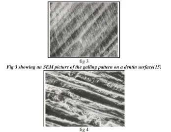 fig 3 Fig 3 showing an SEM picture of the galling pattern on a dentin surface(15) 