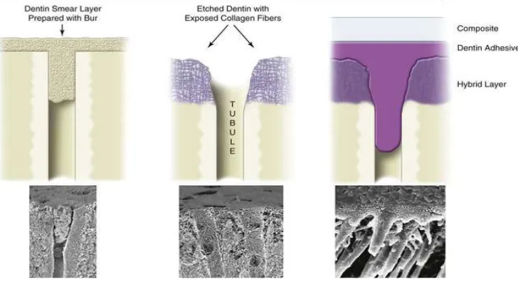 fig 5 Fig 5 showing removal of smear layer after acid etching and formation of resin tags(10) 