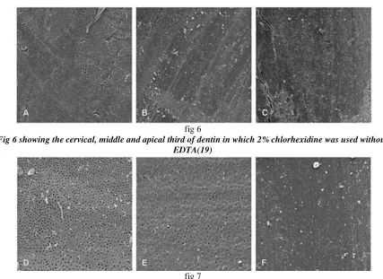 fig 6 Fig 6 showing the cervical, middle and apical third of dentin in which 2% chlorhexidine was used without 