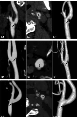 FIG 4. Carotid artery web in 3 patients with TIA (A–C). Sagittal oblique CTA (A1, B1, and C1) showsa shelf-like intraluminal protrusion arising from the posterior wall of the carotid bulb (arrow).Axial CTA (A2, B2, and C2) shows that the membrane is shelf-like, consistent with a carotid arteryweb (arrow); volume reconstruction (A3, B3, and C3) shows the same web inside the vessel(arrow).