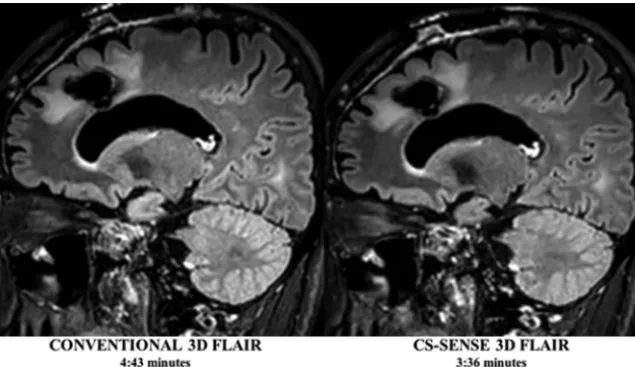 FIG 1. Conventional and CS-SENSE accelerated sagittal 3D T2-FLAIR images from the same pa-tient demonstrate a treated primary brain tumor within the left frontal lobe