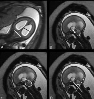 FIG 1. T2-weighted imaging (HASTE) in the coronal (lineA) plane shows the biparietal diameter (white in A) and the ventricular width (black line in A)