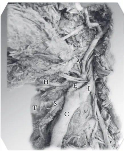 Figure 2. The bifurcation of the right common carotid artery (C)opposite the hyoid bone (H); the external carotid artery (E) liesanteromedial to the internal carotid artery (I) and the origin of thesuperior thyroid artery (S) from the external carotid artery abovethe level of the bifurcation; T — thyroid cartilage.
