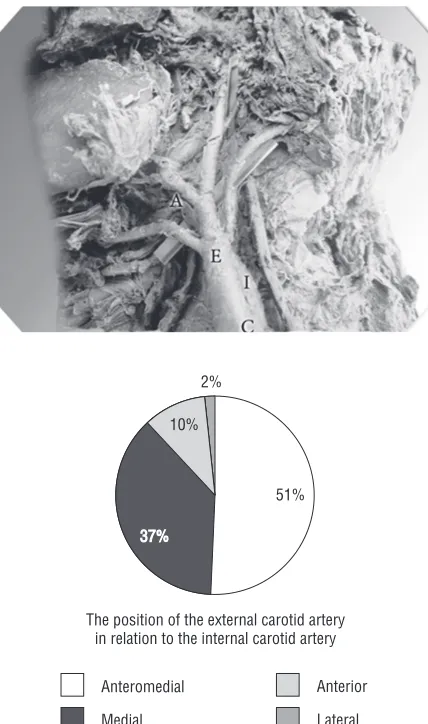 Figure 9. The origin of the ascending pharyngeal artery (A) fromthe external carotid artery (E) arising by two roots above the levelof the bifurcation; I — internal carotid artery; E — external carotidartery; S — superior thyroid artery; C — common carotid artery.