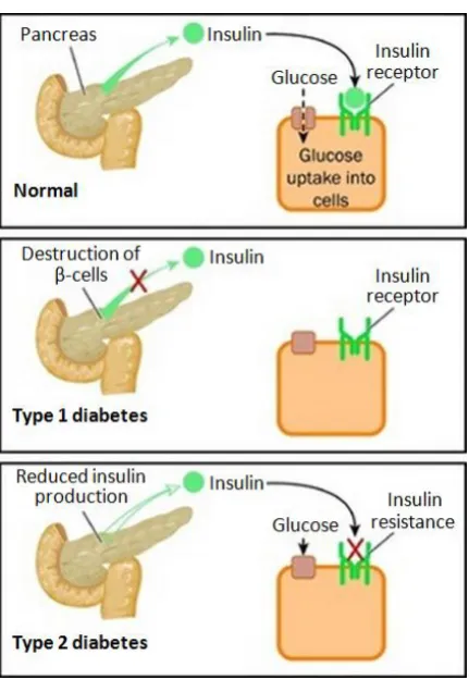 Figure 1.3: Illustration of the pathophysiological differences between normal, type 1 and type 2 diabetes