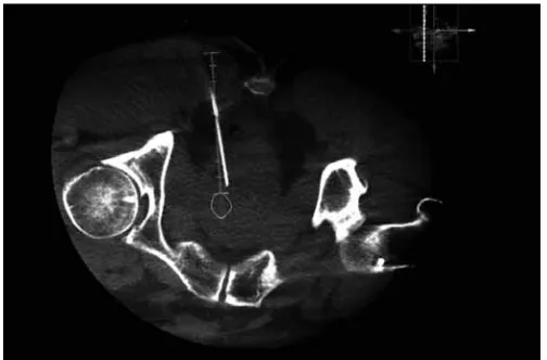 Fig. 2. MP-07.12. Real-time cone beam CT of the same patient as in Fig. 1 with the biopsy needle in place