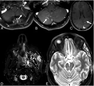 FIG 1. A 49-year-old woman with VMs and DVAs. VMs are in the left temporal region, orbit,zygomaticofacial region, and mandible (A and B)