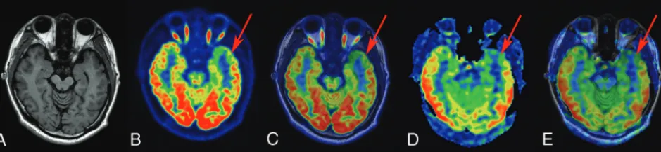 FIG 2. FCD type Ib in a 23-year-old patient with a history of seizures, onset at 14 years of age.lobectomy, histopathologic ﬁndings showed FCD type Ib