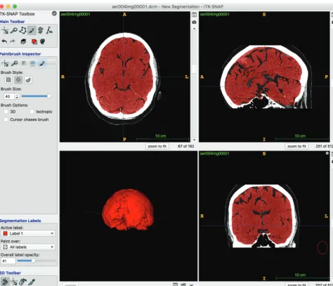 FIG 2. ITK-SNAP screenshot showing total brain volume segmentation.