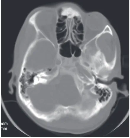Table 1. Dimensions of the sphenoid sinus in all patients