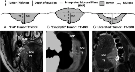 FIG 1. A schematic representation of 3 main types of tumors. A, Flat tumors have the interpreted mucosal plane at the same level as the tumor;thus, depth of invasion and tumor thickness should be measured identically (TT � DOI)
