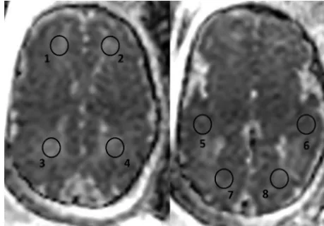 FIG 1. ADC calculation was performed on 8 circular ROIs: 2 on thewhite matter of both frontal (1, 2), parietal (3, 4), temporal (5, 6), andoccipital lobes (7, 8)