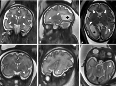 Table 1: Demographic and clinical characteristics of fetuses with white matter T2hyperintense signala