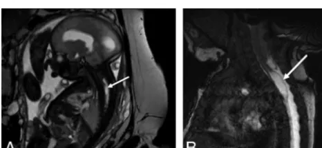 FIG 3. Axial T2-single-shot FSE image through a 23 weeks’ 3 days’gestational age fetus (A) with a myelocele demonstrates splitting ofthe neural placode (arrow), consistent with a type II split cord mal-formation