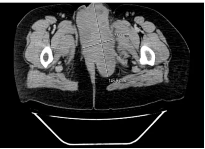 Figure 1. Initial computed tomography scan of the pelvic showing a 147 mm × 78 mm low rectum, obturator muscle, ischion and pubis.sized mixed mass lesion in the left vulva with locally extension to the vaginal, anal canal,  
