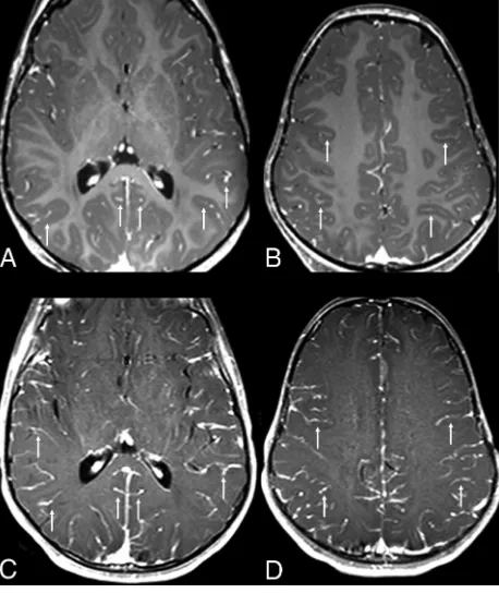 FIG 4. Examples of grade 2 pseudo-LMCE, demonstrated on both GEon axial (TIWI and SE TIWI in 2 different patients