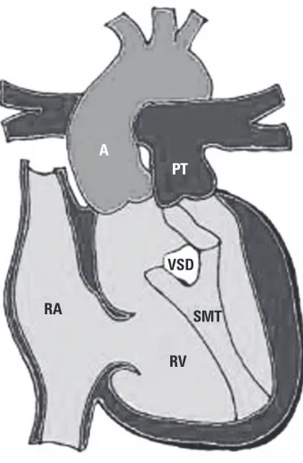 Figure 1. Schematic diagram of a normal cardiac structure;A — aorta, PT — pulmonary trunk, LV — left ventricle,RV — right ventricle, RA — right atrium, IVS — interventricularseptum, SVC — superior vena cava.