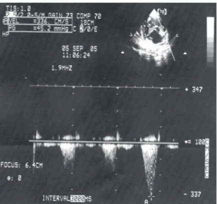 Figure 6. Echocardiographic image showing aneurysm on inter-atrial septum.