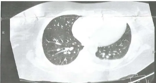 Figure 1. Pulmonary embolism of the left and right proximal trunks with a small amount of left reaction pleurisy, right distal branch thrombus