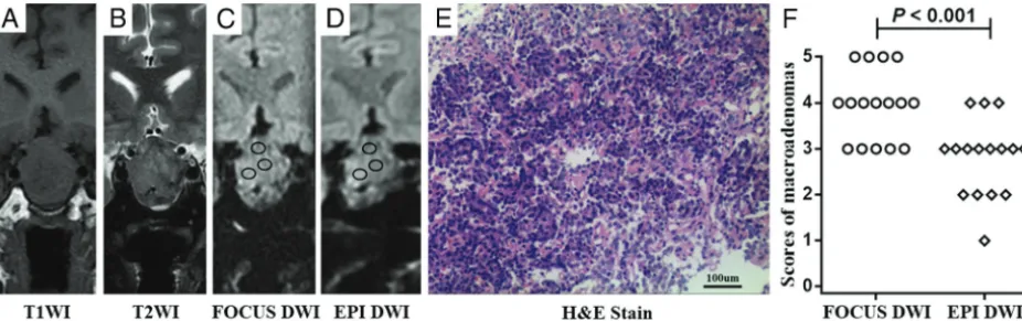 FIG 2. A–D, Images of a 51-year-old man with immunohistochemical staining–proved nonfunctional adenoma