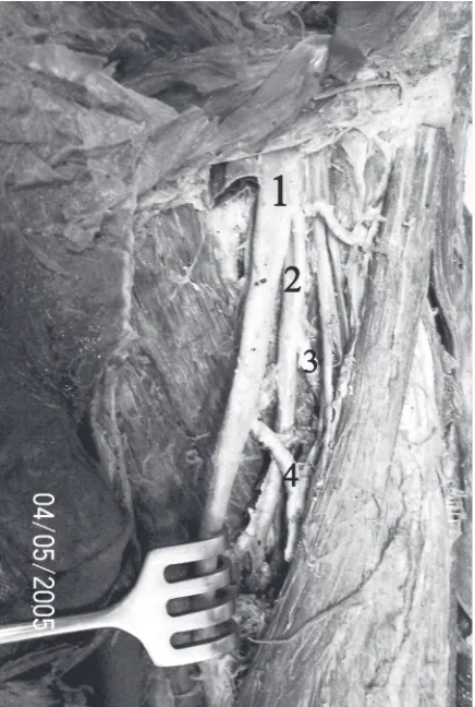 Figure 2. The left inguinal region of the case in which theascending and descending branches of the lateral circumflex femoral artery (LCFA) branched from the deep femoral artery(DFA) and the femoral artery (FA) respectively; 1 — FA; 2 — DFA;3 — ascending branch of LCFA; 4 — descending branch of LCFA.