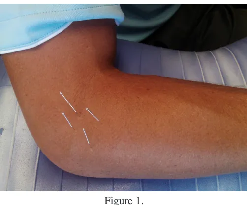 Figure 1. Four acupuncture needles were superficially inserted 