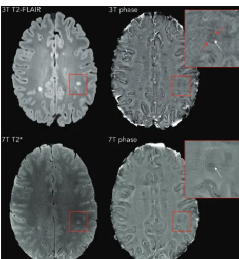 FIG 2. Representative examples of MS lesions in which a paramagnetic rim (easily seen on both 7T and 3T phase images