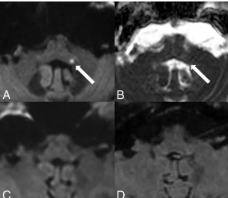 FIG 7. Subacute ischemic infarct in the right ﬂocculus. MR imagingresents a subacute ischemic infarct in the right ﬂocculus