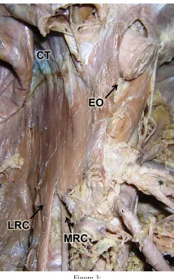 Figure 3: duplication of the right crus of the diaphragm has been re-