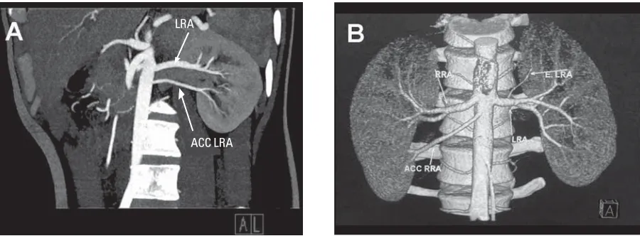 Table 1. Comparison of right side and left side kidney and artery characteristics