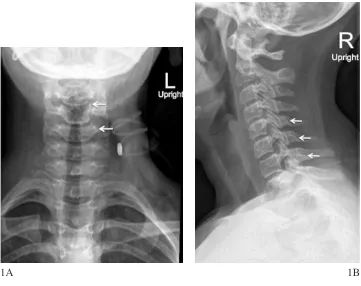 Figure 1: AP lower (A) cervical radiograph revealed scalloping at the left lateral border 