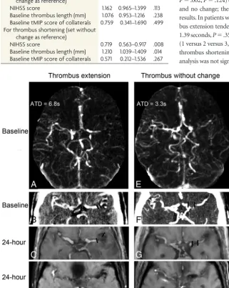 Table 4: Logistic regression for prediction of thrombus extensionand shortening, including baseline tMIP score of collaterals in themodel