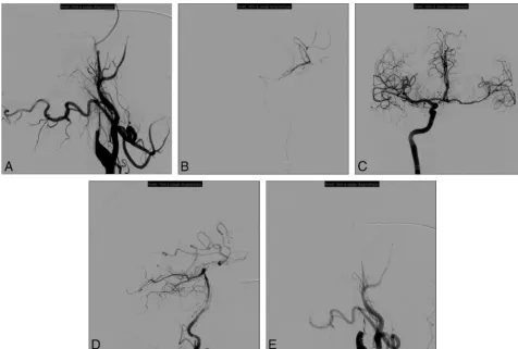 FIG 1. Patient presenting with right hemiplegia and aphasia (NIHSS score � 20). Initial MR imaging revealed a DWI-ASPECTS of 6 after 4.5 hourssince symptom onset associated with left tandem ICA and middle cerebral artery occlusions