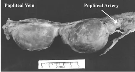 Figure 1. A rare case of double popliteal aneurysm.