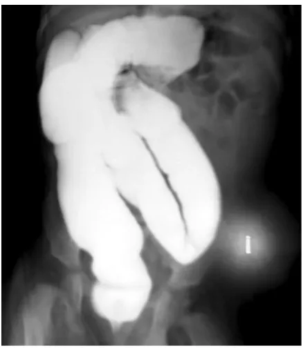 Figure 3. Rotation of the main part of the small intestine on its mesentery; this has led to gangrene of a large part of the jejunum andileum (a); note the gangrene (B).