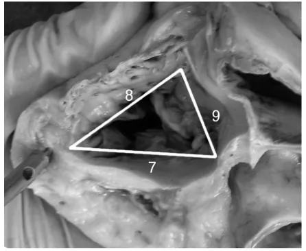 Figure 1. Scheme of location of accessory cusps in subtypes of Type 2.