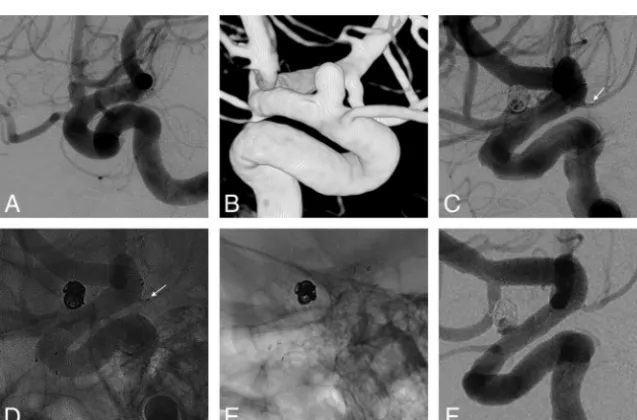 FIG 3. Aposterior communicating artery, as shown on postembolization angiography.ﬂow to the PcomA with malposition of the stent marker is patent on 5-year-follow-up cerebralangiography