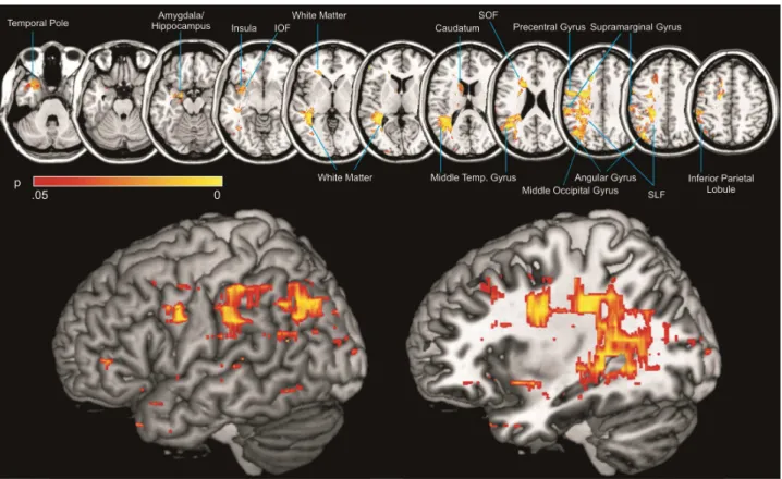 Figure 2: Results of the multivariate lesion-behaviour mapping 
